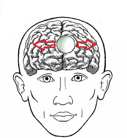 Инсульт левого полушария головного. Боль в левом полушарии головы. Болит левое полушарие головы. Болит правое полушарие головы. Ноет левое полушарие головы.